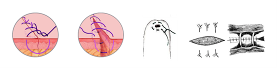 Common Surgical Suture Knotting Methods